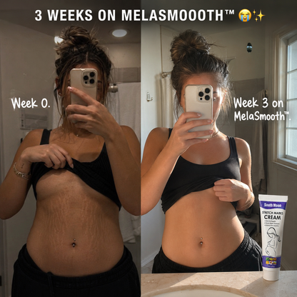 MelaSmooth™ - Stretch Mark Repair Cream