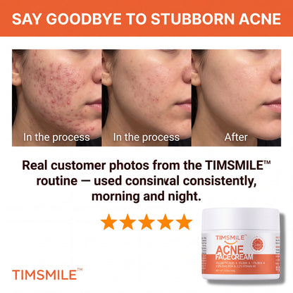 Timsmile™ – Herbal Acne Treatment